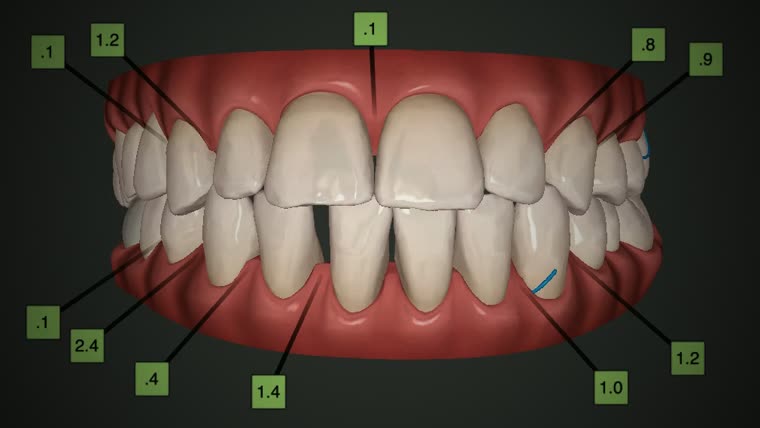 Plano de tratamento real: os dentes na posição inicial, com apinhamento e desalinhamento.
